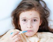 The primary school parents’ guide to chickenpox
